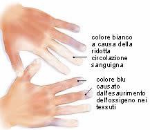 colore delle mani con il freddo